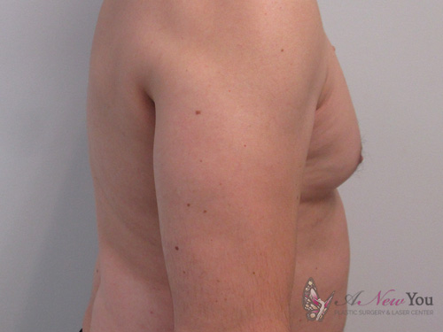 Gynecomastia Before - Chicago, IL