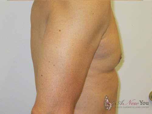 Gynecomastia After - Chicago, IL