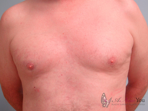 Gynecomastia Before - Chicago, IL