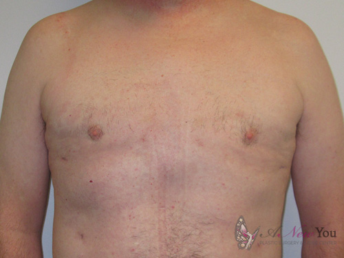 Gynecomastia After - Chicago, IL