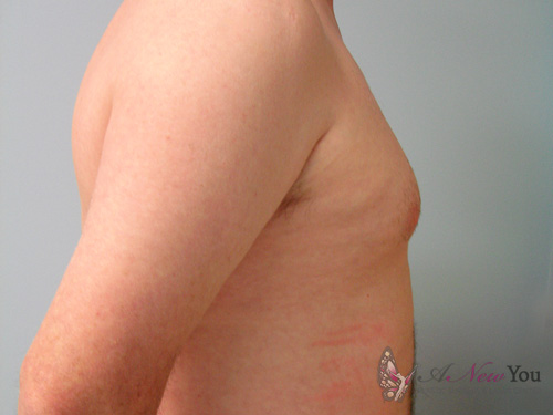 Gynecomastia Before Gynecomastia Before - Chicago, IL