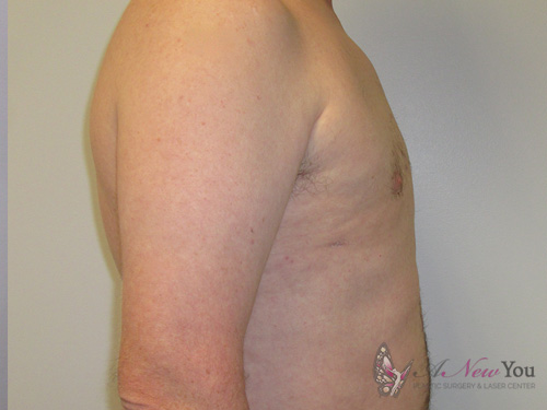 Gynecomastia After - Chicago, IL