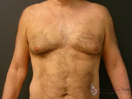 Gynecomastia Before - Chicago, IL