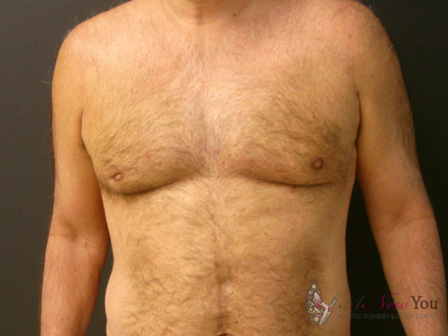 Gynecomastia After - Chicago, IL