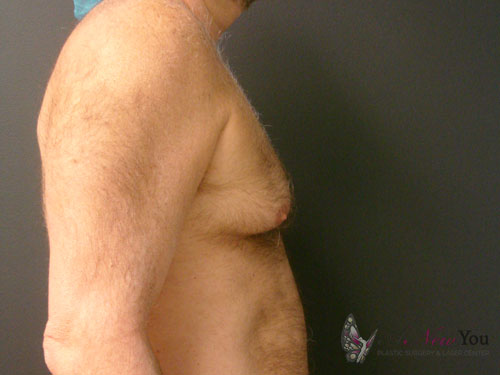 Gynecomastia Before - Chicago, IL