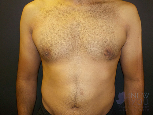 Gynecomastia After - Chicago, IL