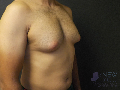 Gynecomastia Before - Chicago, IL