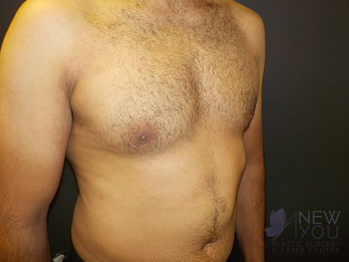 Gynecomastia After - Chicago, IL