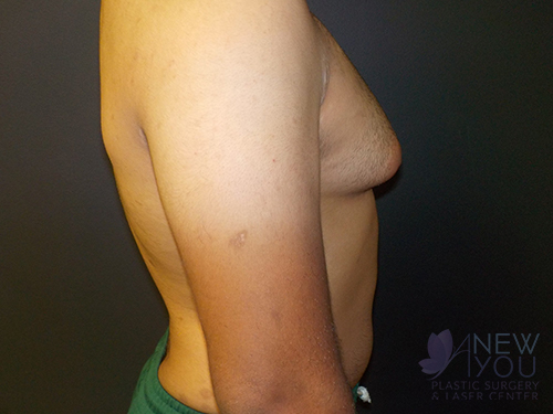 Gynecomastia Before - Chicago, IL