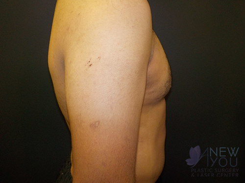 Gynecomastia After - Chicago, IL