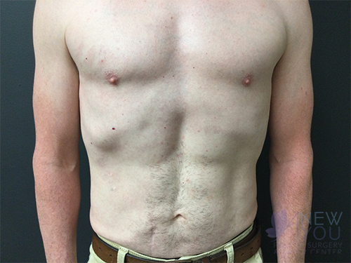 Gynecomastia After - Chicago, IL