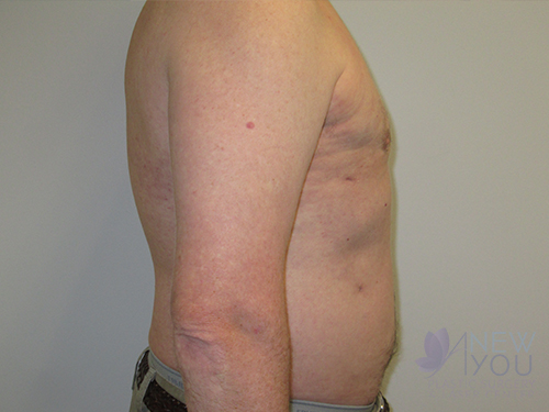 Gynecomastia Before - Chicago, IL