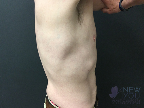 Gynecomastia After - Chicago, IL