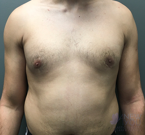 Gynecomastia After - Chicago, IL