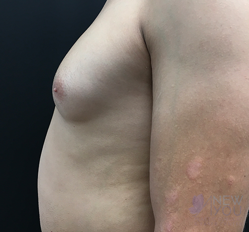 Gynecomastia Before - Chicago, IL