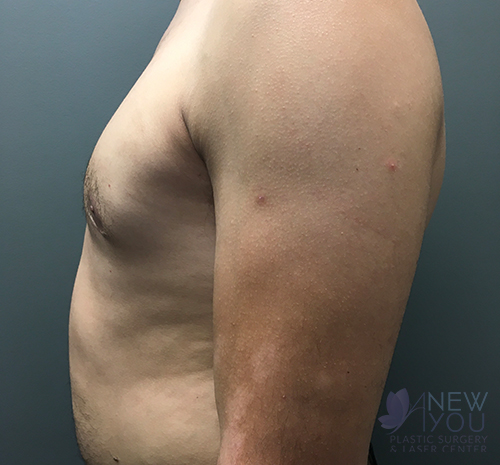 Gynecomastia After - Chicago, IL