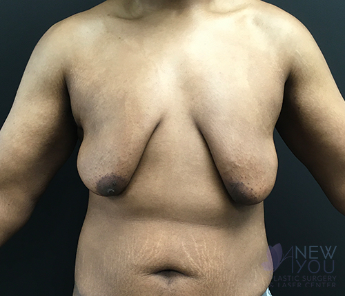 Gynecomastia Before - Chicago, IL