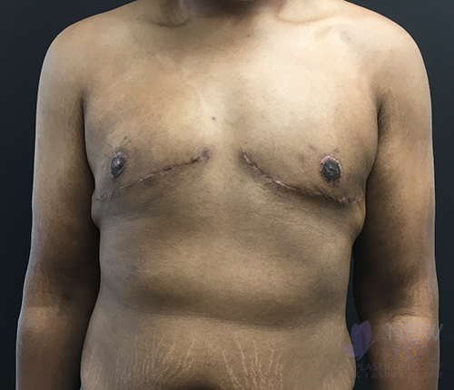 Gynecomastia After - Chicago, IL