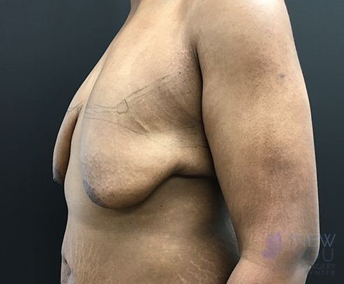 Gynecomastia Before - Chicago, IL