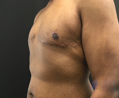 Gynecomastia After - Chicago, IL