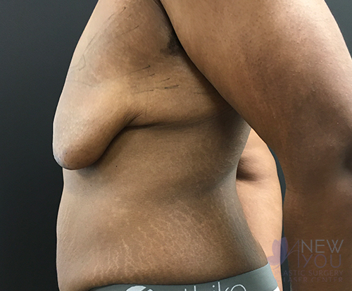 Gynecomastia Before - Chicago, IL