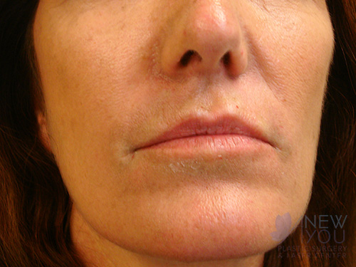 Lip Augmentation Before - Chicago, IL