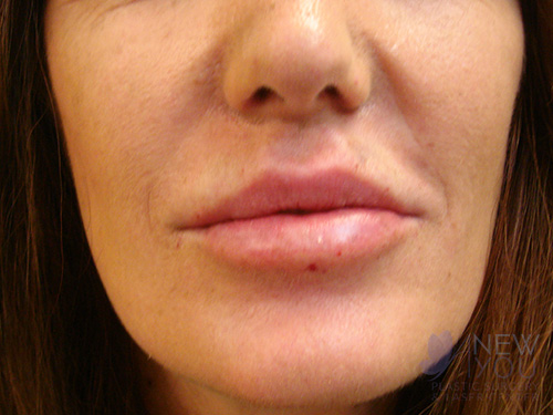 Lip Augmentation After - Chicago, IL