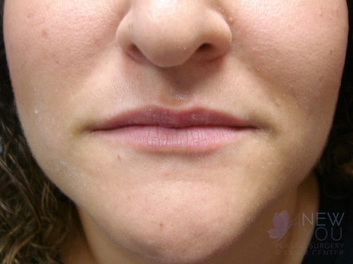 Lip Augmentation Before - Chicago, IL