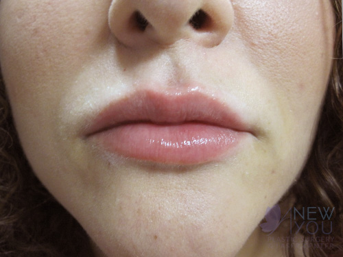 Lip Augmentation After - Chicago, IL