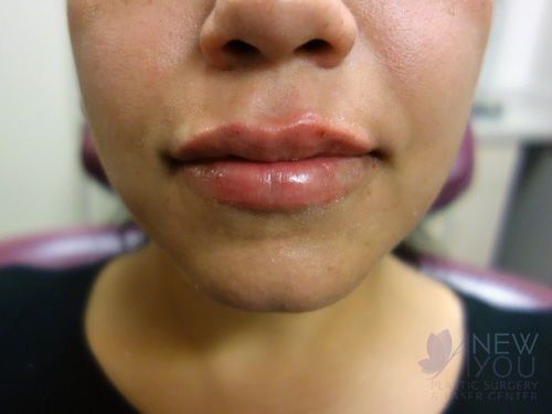 Lip Augmentation After - Chicago, IL