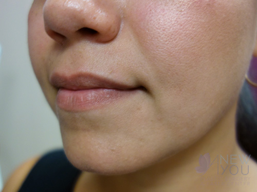 Lip Augmentation Before - Chicago, IL