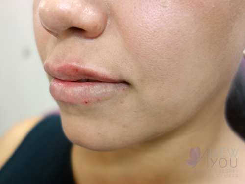 Lip Augmentation After - Chicago, IL