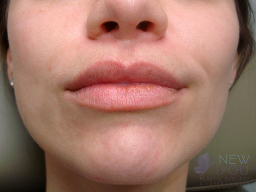 Lip Augmentation Before - Chicago, IL