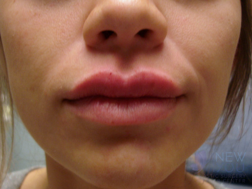 Lip Augmentation After - Chicago, IL