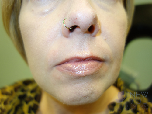 Lip Augmentation Before - Chicago, IL