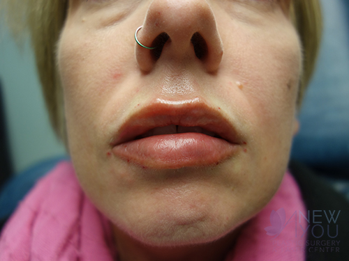 Lip Augmentation After - Chicago, IL