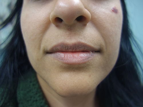 Lip Augmentation Before - Chicago, IL