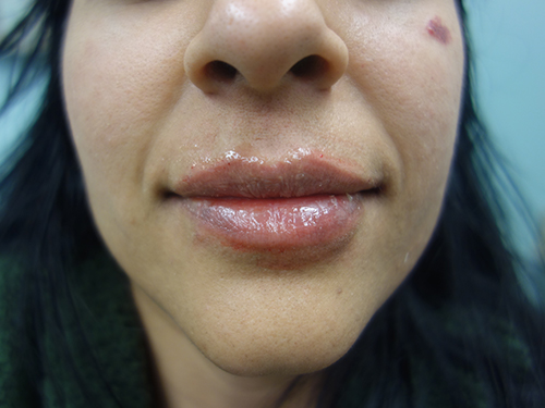 Lip Augmentation After - Chicago, IL