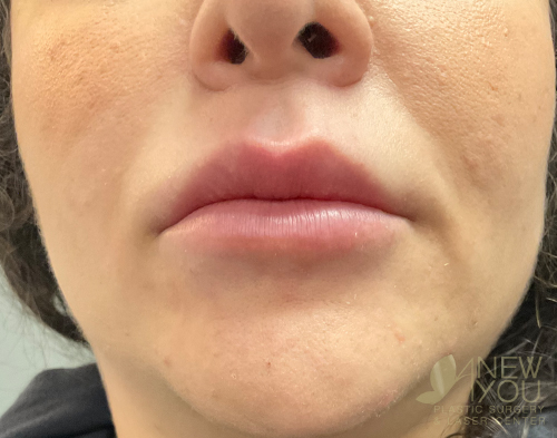 Lip Augmentation Before - Chicago, IL