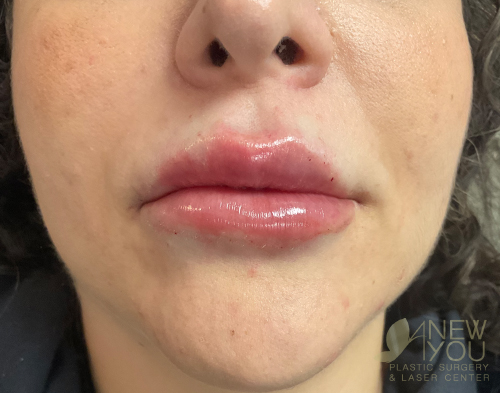 Lip Augmentation After - Chicago, IL