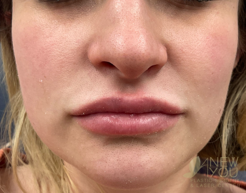 Lip Augmentation Before - Chicago, IL