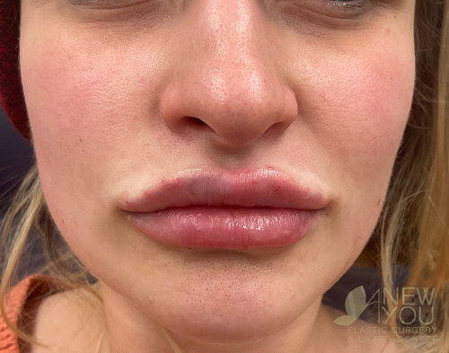 Lip Augmentation After - Chicago, IL