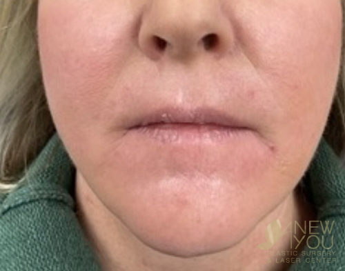 Lip Augmentation Before - Chicago, IL