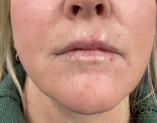 Lip Augmentation After - Chicago, IL