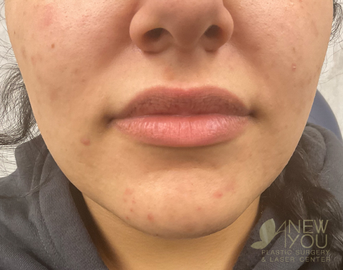 Lip Augmentation Before - Chicago, IL