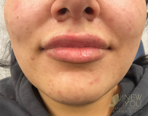 Lip Augmentation After - Chicago, IL