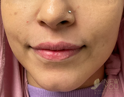 Lip Augmentation Before - Chicago, IL