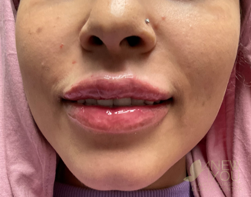 Lip Augmentation After - Chicago, IL