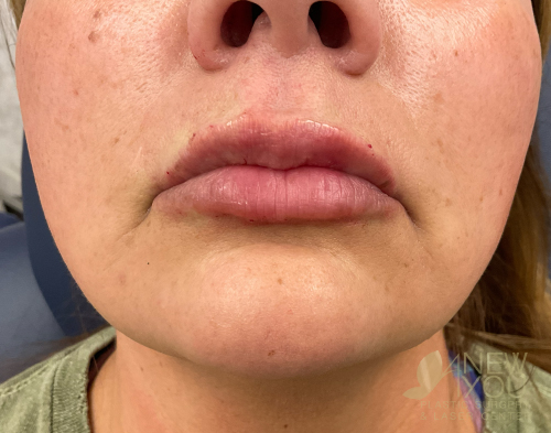 Lip Augmentation After - Chicago, IL