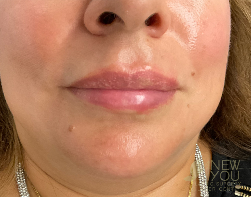 Lip Augmentation Before - Chicago, IL